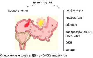 Симптомы и причины возникновения дивертикулеза кишечника