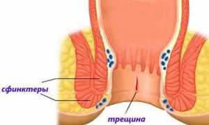 Почему возникает анальная трещина у ребенка и как её лечить?
