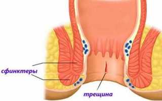 Почему возникает анальная трещина у ребенка и как её лечить?
