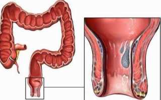 Лечение мокнущего геморроя