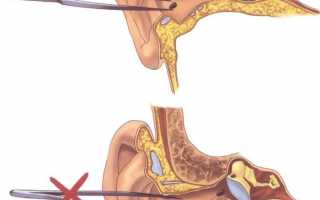 Инородное тело в ухе — первая помощь