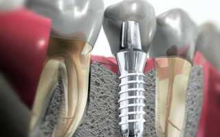 Когда можно проводить установку импланта после процедуры удаления зуба?
