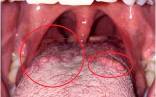Как можно эффективно избавиться от волдырей на языке?