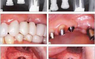 Периимплантит – профилактика лучше лечения