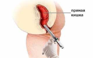 Острый гнойный парапроктит: причины, симптомы и методы лечения
