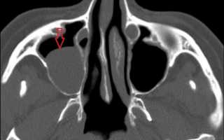 Кисты околоносовых пазух — симптомы и лечение
