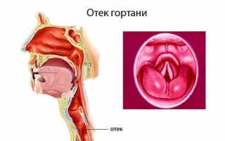 Отек гортани — симптомы и лечение