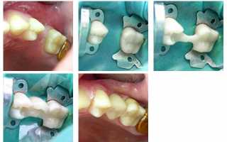 Особенности и виды зубного протезирования без обточки соседних зубов