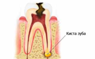 Из-за чего под коронкой может образоваться киста и как от нее избавиться?