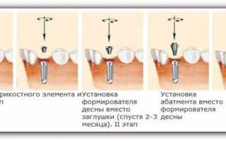 Особенности применения формирователя десны при имплантации зубов