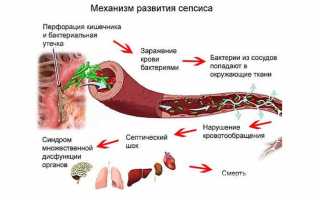 Сепсис — причины, симптомы, диагностика и лечение