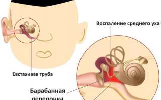 Лечение острого среднего серозного отита у детей и взрослых