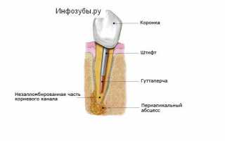 Как снять боль в домашних условиях, если болит зуб под коронкой?