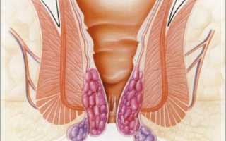 Почему появляется зуд при анальной трещине и как от него избавиться?