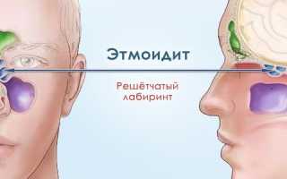 Этмоидит: причины, симптомы и лечение