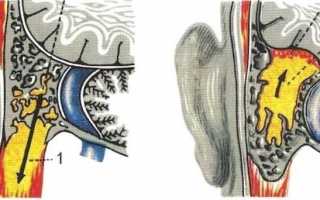 Отогенный сепсис — диагностика и лечение