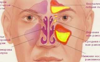 Чем отличается синусит от гайморита?