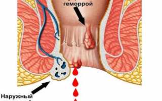 Какие бывают выделения при геморрое?