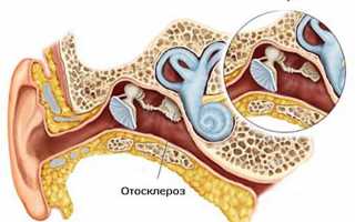 Отосклероз — симптомы и лечение