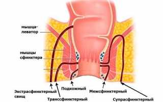 Свищ прямой кишки — что это такое?