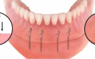 Когда используются мини-импланты в стоматологии?