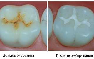 Характерные особенности и преимущества световой пломбы