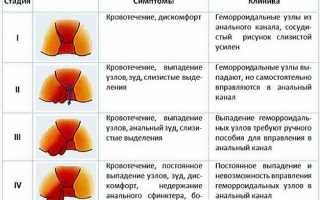 Как можно определить стадии геморроя?