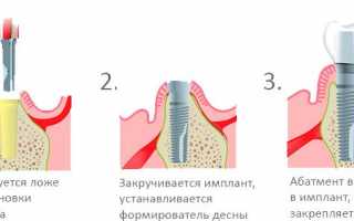 Зачем нужен абатмент при имплантации зубов и какие есть его разновидности?