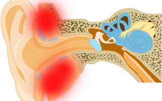 Что такое мастоидит: лечение и профилактика