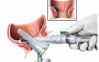 Что такое аноскопия и как проводится процедура?