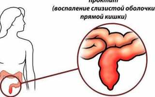 Симптомы и лечение хронического проктита