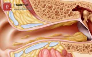 Почему в ушах появляется сухая сера?