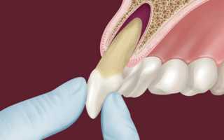 Преимущества и недостатки реплантации зуба, а также особенности процедуры