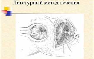 Хирургическое лечение парапроктита