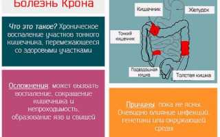 Почему возникает болезнь Крона у ребёнка, как её распознать и можно ли вылечить?