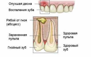 Воспаление корня зуба – как проводят лечение?