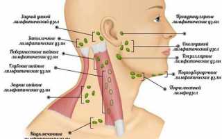 Симптомы и лечение подчелюстного лимфаденита